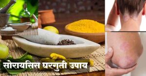 Read more about the article सोरायसिस घरगुती उपाय – 8 Best Psoriasis Home Remedies