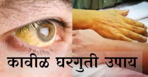 Read more about the article कावीळ घरगुती उपचार – Top 10 Best Home Remedies