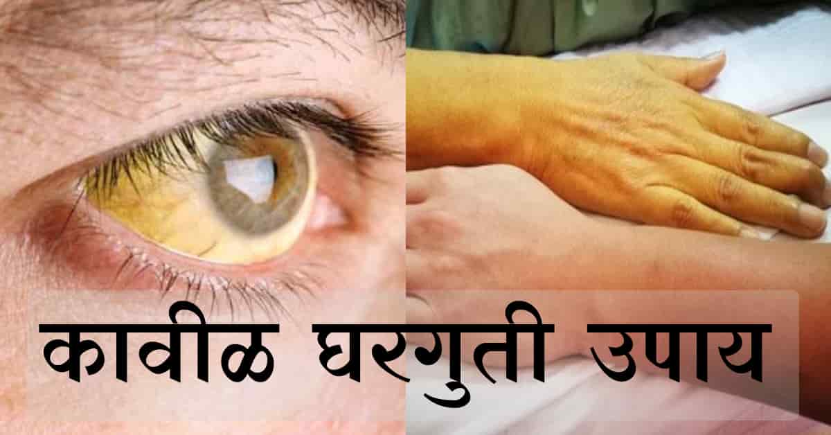 You are currently viewing कावीळ घरगुती उपचार – Top 10 Best Home Remedies