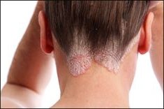 सोरायसिस घरगुती उपाय / सोरायसिस घरगुती उपचार /सोरायसिस मराठी माहिती / psoriasis treatment in marathi - सोरायसिस