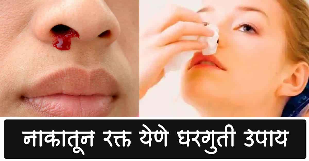 You are currently viewing नाकातून रक्त येणे घरगुती उपाय – Best 12 Home Remedies