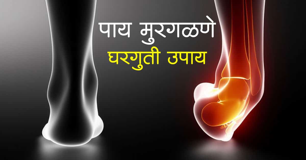 Read more about the article पाय मुरगळणे घरगुती उपाय – Best 8 Home Remedies for Leg Twist