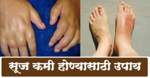 Read more about the article सुज कमी होण्यासाठी उपाय – 12 Best Remedies For Inflammation