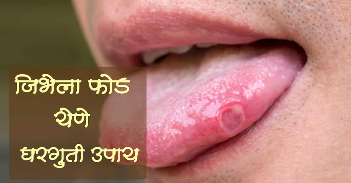 You are currently viewing जिभेला फोड येणे घरगुती उपाय – Best 13 Home Remedies
