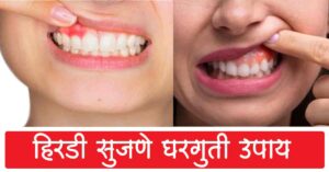Read more about the article हिरडी सुजणे घरगुती उपाय – Top 10 Best Home Remedies