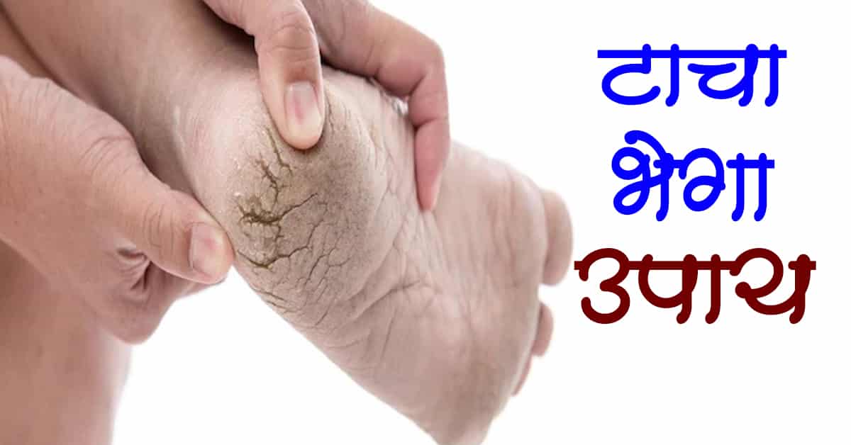 Read more about the article टाचा भेगा उपाय / पायाच्या भेगा उपाय – 8 Best Remedies On Heel Splits