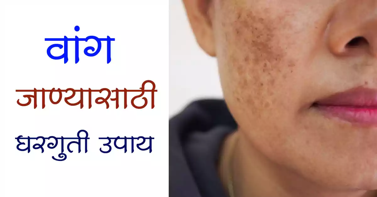 You are currently viewing वांग जाण्यासाठी घरगुती उपाय – Top 5 Best Home Remedies