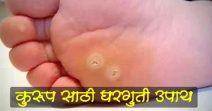 Read more about the article कुरूप साठी घरगुती उपाय – Kurup On Foot Best 12 home Remedies