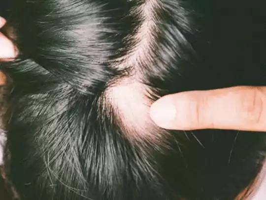 केस गळण्याची कारणे/ केस गळणे थांबवण्यासाठी उपाय/ केस पातळ होणे / केस गळणे थांबवण्यासाठी घरगुती उपाय / hair fall marathi