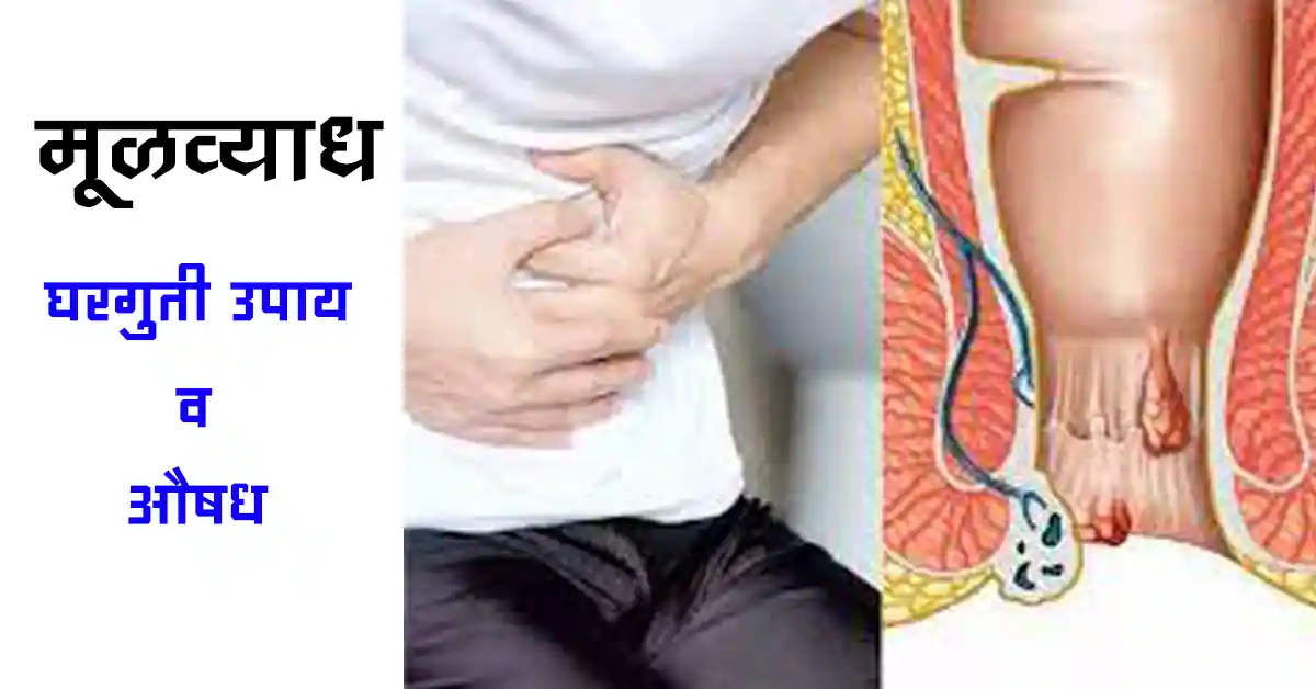 Read more about the article मूळव्याध वर घरगुती उपाय – 11 Best Home Remedies
