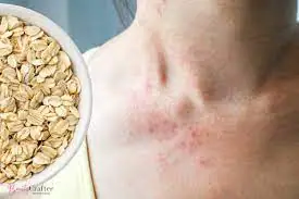 इसब त्वचारोग घरगुती उपाय/ इसब/ eczema in marathi / eczema treatment in marathi /  इसब उपचार एकजे